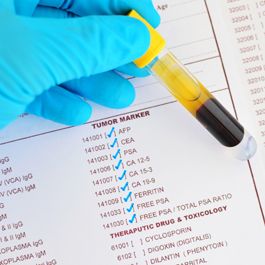 A rák leggyakoribb típusai ellen: 5 féle laboratóriumi tumor marker vizsgálat Nőknek, Férfiaknak 