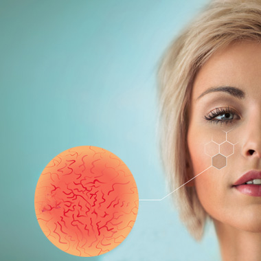 Mondj búcsút a csúnya értágulatoknak végleg: A rosacea okának feltárása IBR-SYSTEM felméréssel 