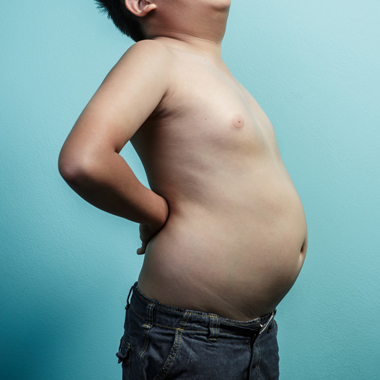 Óvd meg gyermeked a SÚLYOS következményektől! Gyermek obezitológia, a gyermekkori elhízás kivizsgálása 