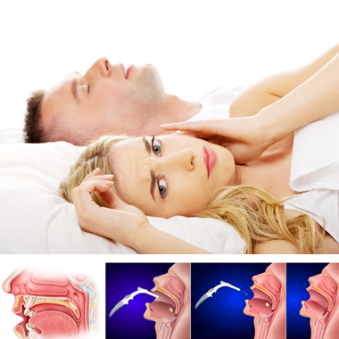 Kerüld el a horkolás okozta szívrohamot és agyi infarktust Somnoplasty eljárással