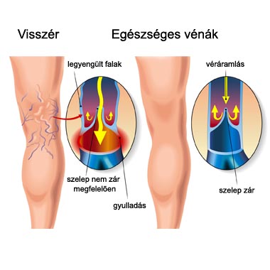 Kékeszöldesen erezett lábak? Végre a visszért is elfelejtheted: ORVOSI visszér eltüntető kezelés