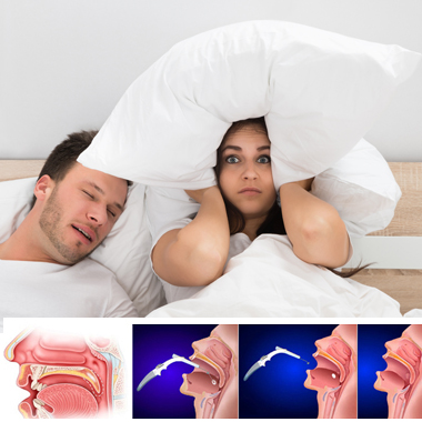 Horkolsz, vagy hallgatod? 2 kezeléses horkolást megszüntető műtét nélküli Somnoplasty terápiás eljárás, neves fül-orr-gégésztől