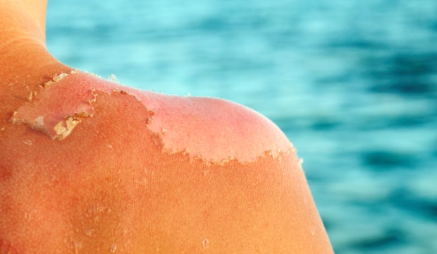 Hámlás - a bőrsejtek tömeges öngyilkossága