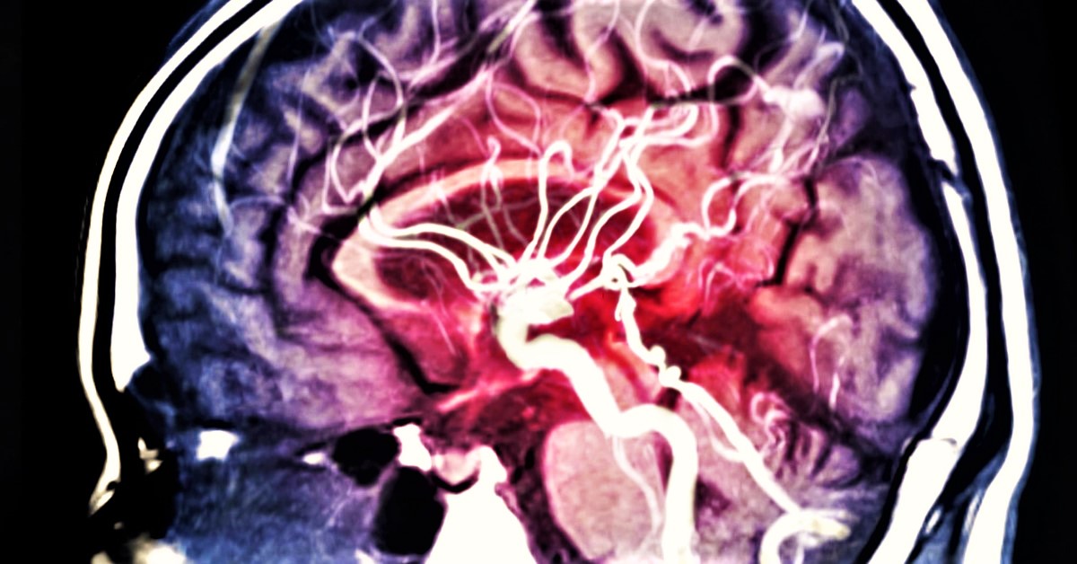 Tippek az agyvérzés megelőzésére