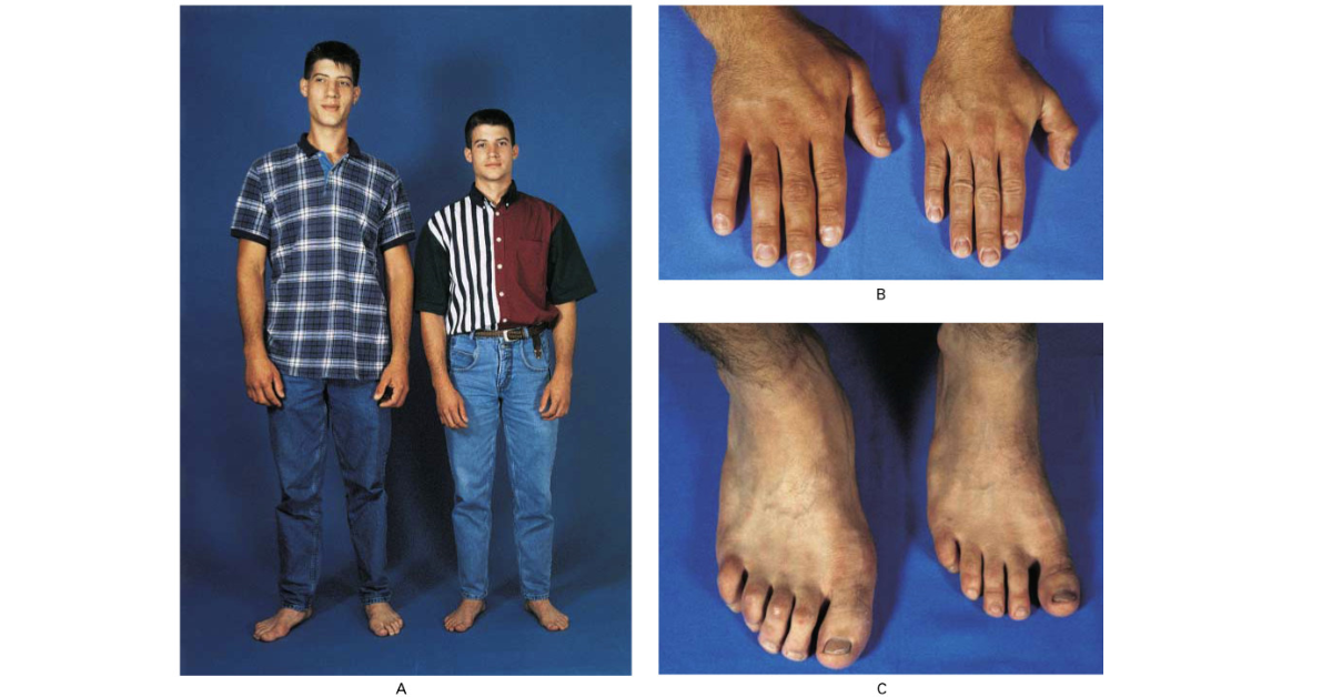 Még mielőtt túl nagyra nőne a probléma – ismerjük meg az akromegáliát