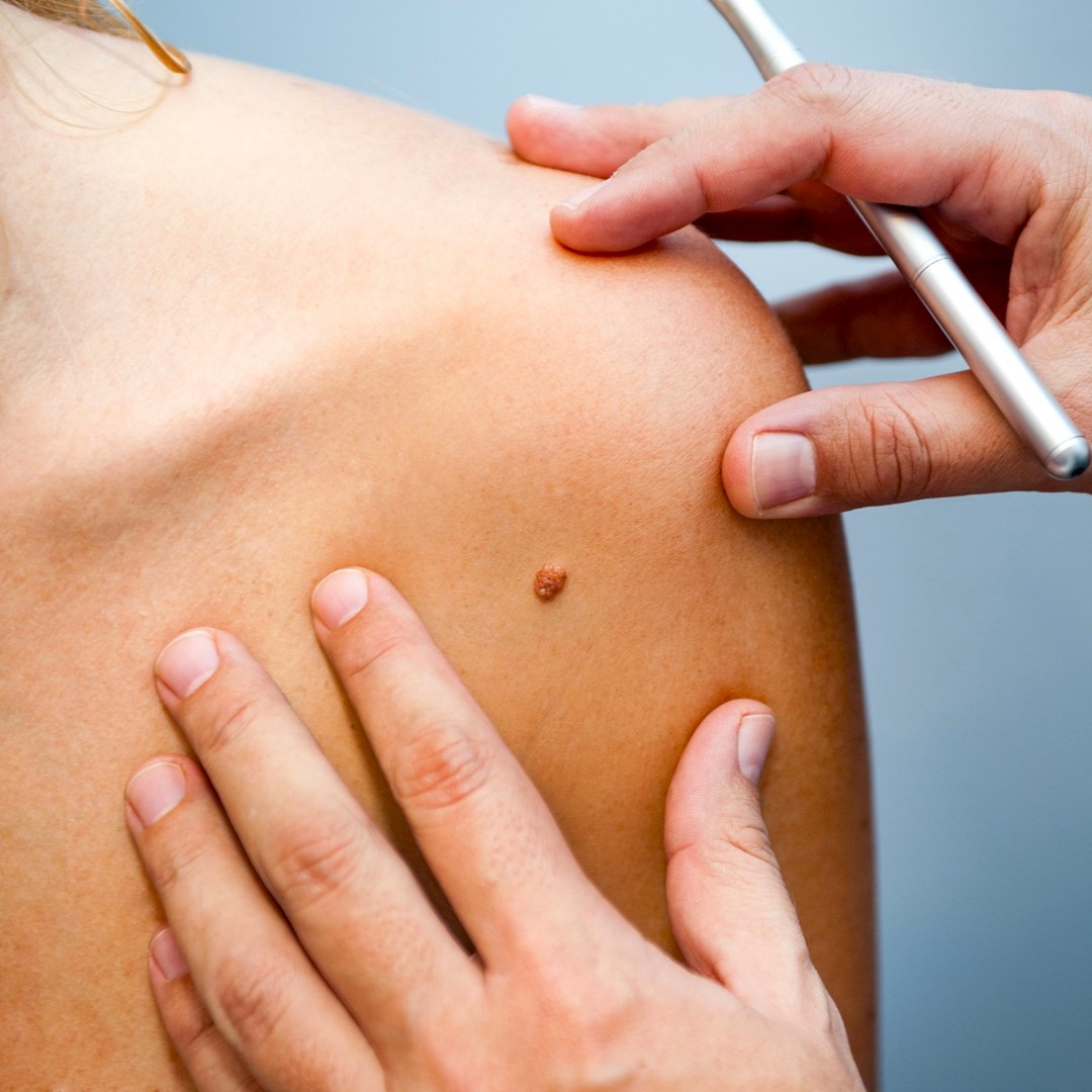 Szakorvosi dermatoszkópos anyajegyszűrés a teljes testen