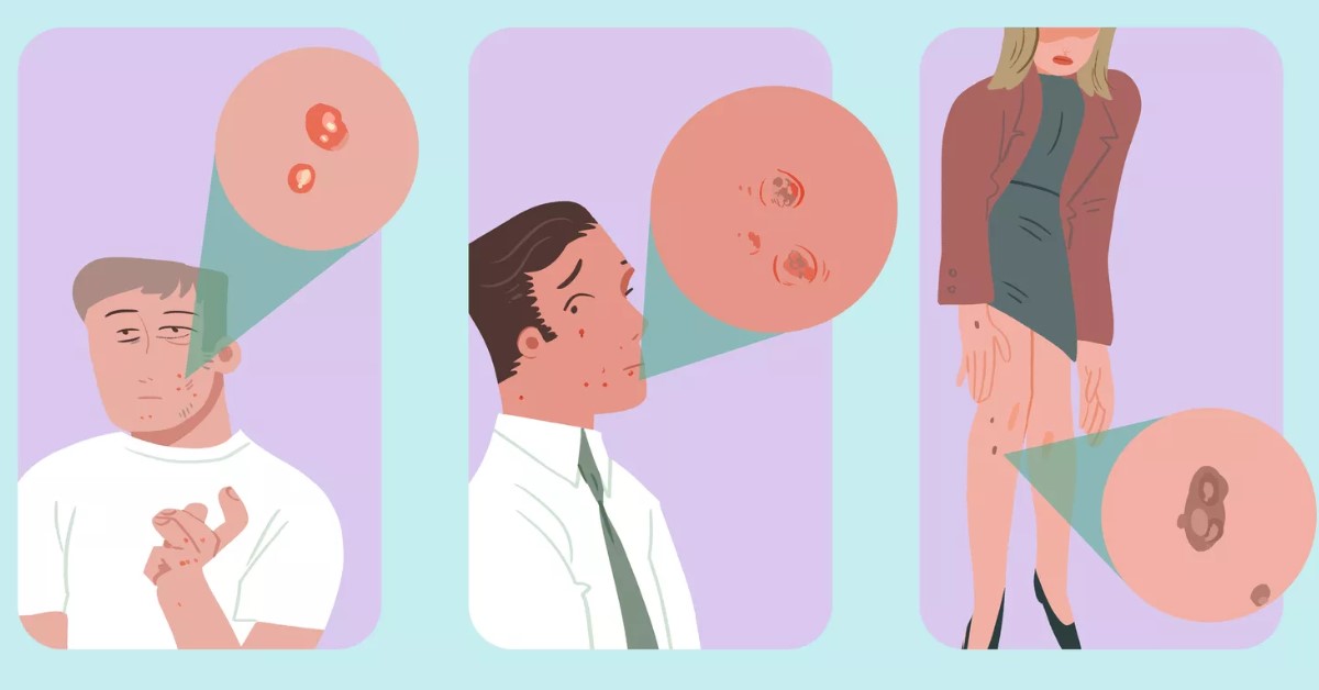 A leggyakoribb bőrrák típusok 5 fontos jele