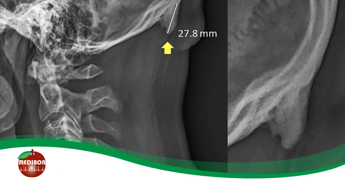 Meghökkentő felfedezés derült ki: a sok mobilozástól plusz csont nőhet a koponyán!