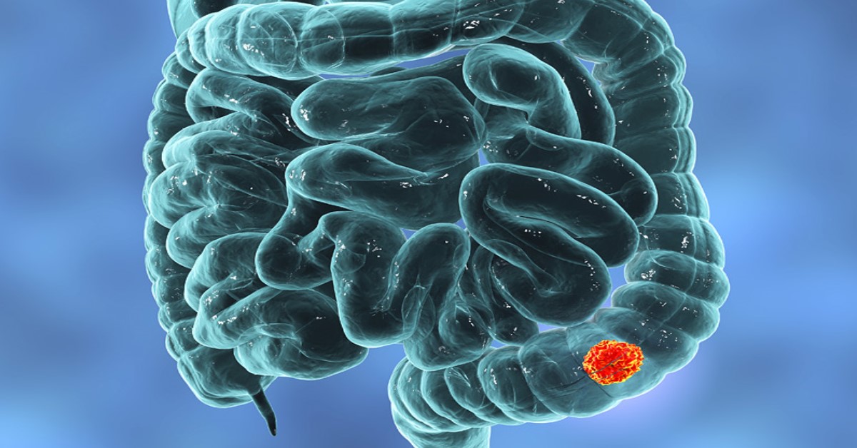 Szeptember elején indul az országos vastagbélrákszűrési program