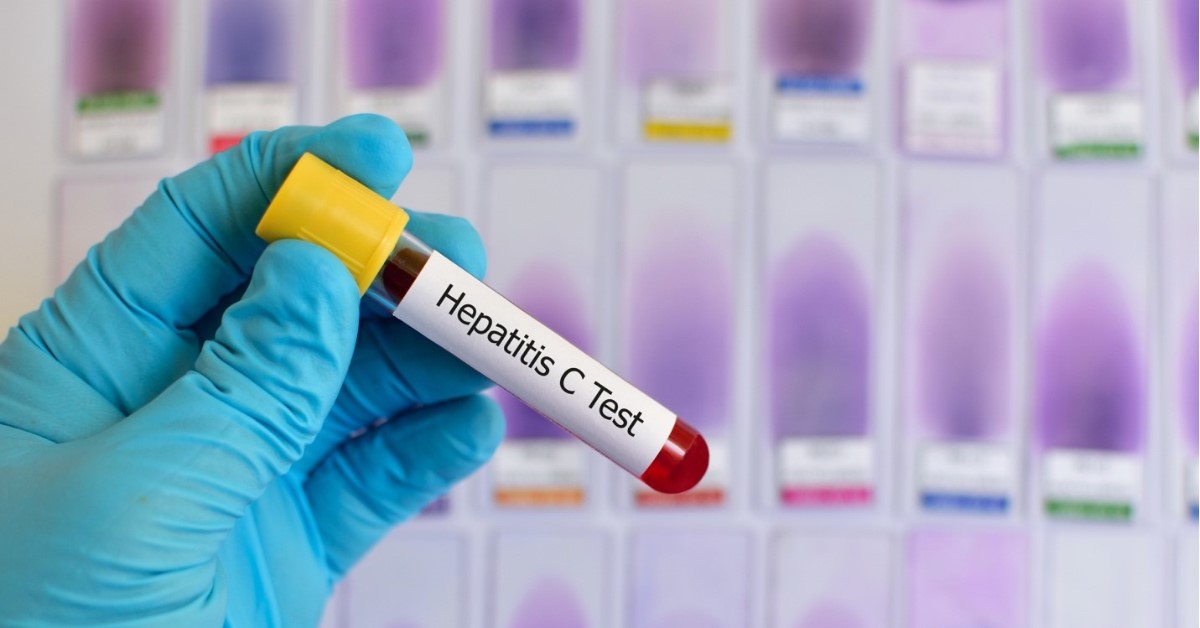 INGYENES HEPATITIS C SZŰRÉS ORSZÁGSZERTE