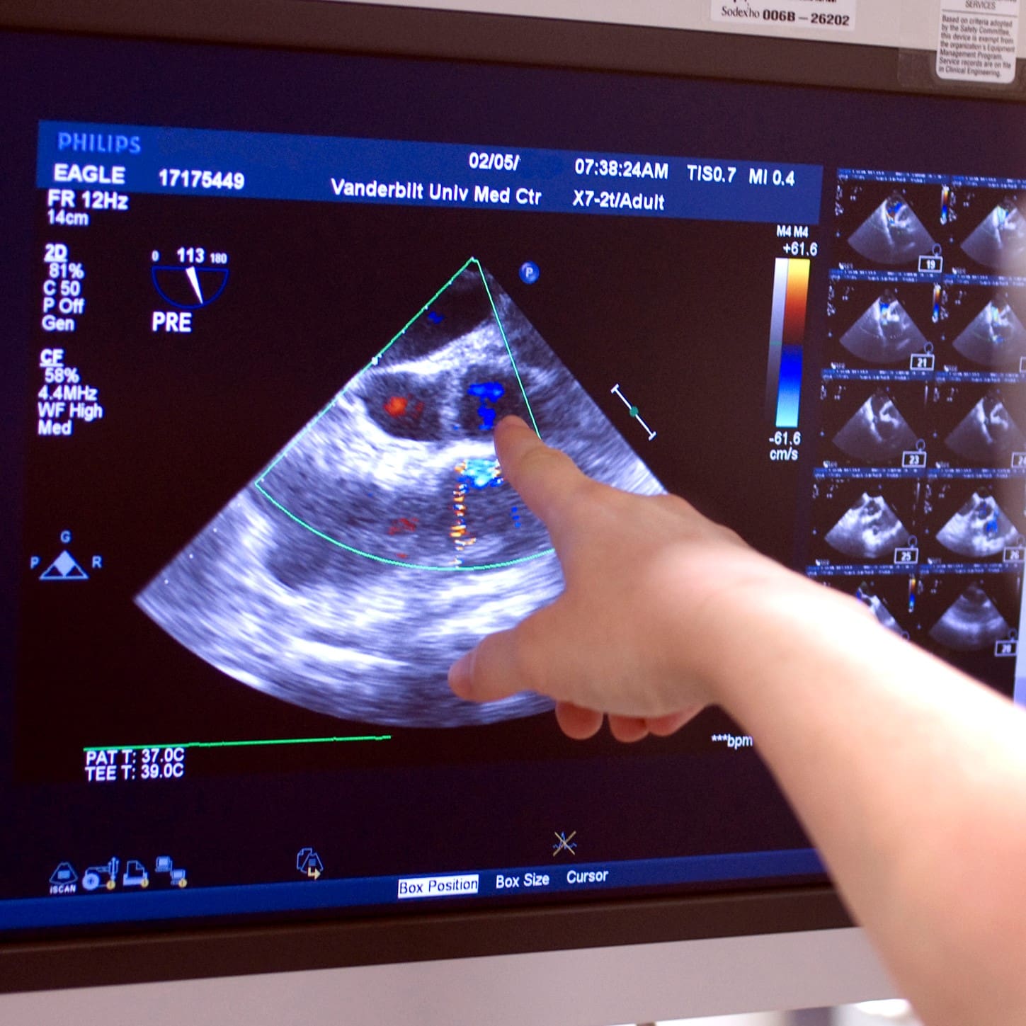 Kardiológiai vizsgálat szívultrahanggal, Dr. Pál Tamás főorvos, a kardiológiai diagnosztika szakértője végzi