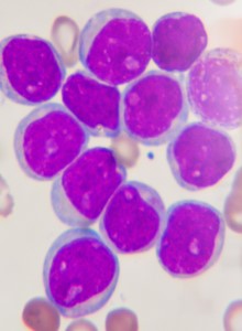 Előrelépés a felnőttkori leukémia kezelésében - hála a magyar tudósok munkájának is