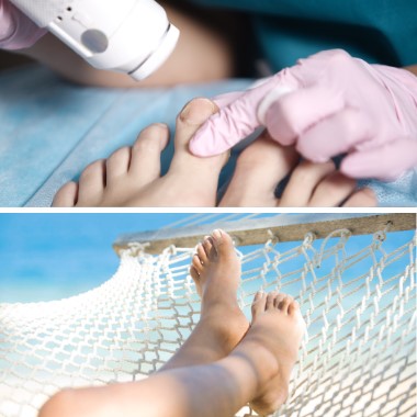 Lézeres körömgomba megszüntető kezelés kézre / lábra