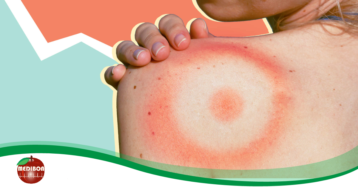 Lyme-kór: miért kezelik félre sokszor?