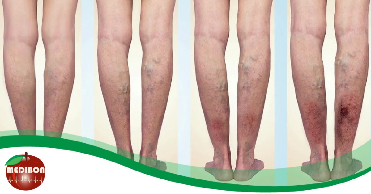 Vedd komolyan: a visszeresség végzetessé is válhat