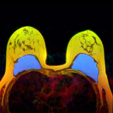 Mellimplantátum ellenőrző MRI vizsgálata a RadiVert betegbarát MR klinikán