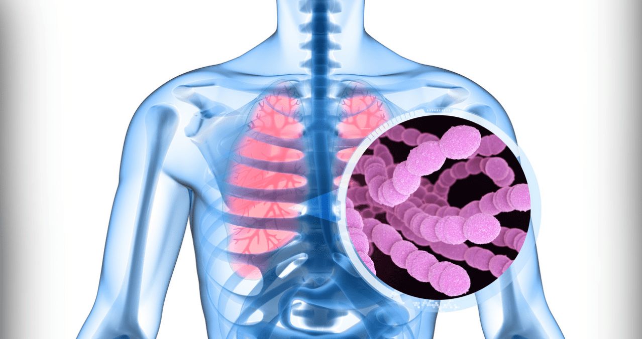 A pneumococcus baktérium okozta fertőzés akár komoly veszélyt is jelenthet