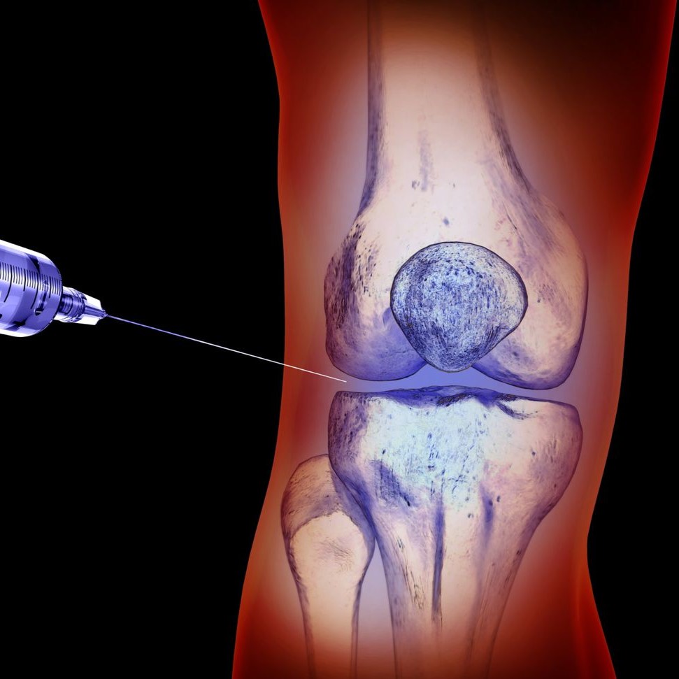 Reumatológiai vizsgálat reumatológus szakorvossal, plusz hialuronsavas injekciós kezelés