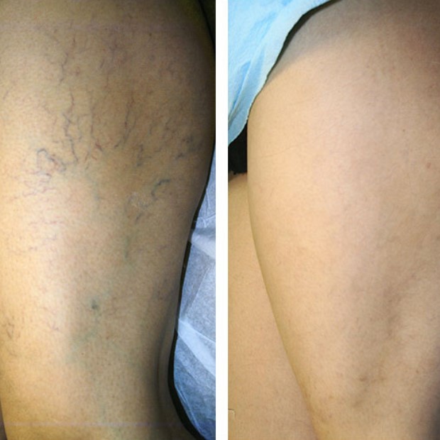 Holnaptól járj szebb lábakon: Seprűvéna kezelés mindkét, teljes lábon, professzionális E-light technológiával