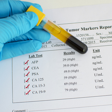 5 féle laboratóriumi tumormarker vizsgálat a rák leggyakoribb típusaira 
