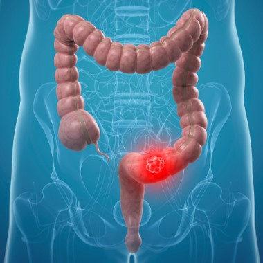 Kétlépcsős vastagbélrák kimutatására szolgáló vizsgálat szakértői véleménnyel