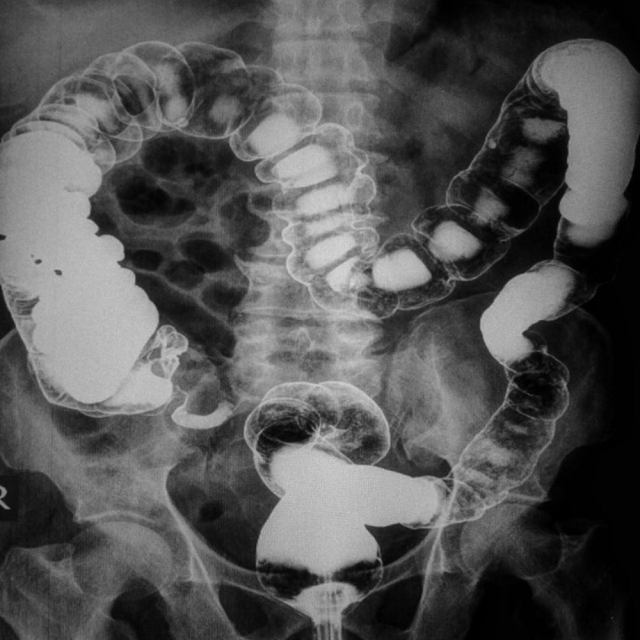 Vastagbélrák kimutatására szolgáló kétlépcsős labor vizsgálat a Gellért Medical Laborban előleg