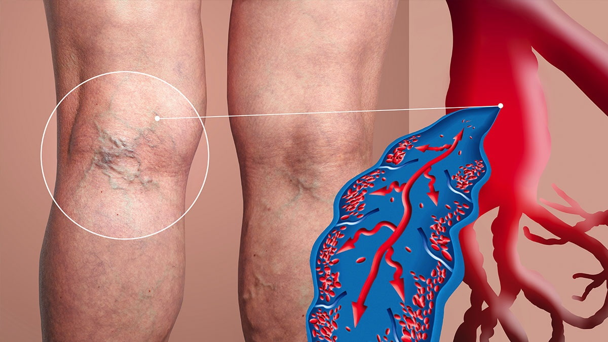Május 15 és 21. között zajlik a Vénák Hete: a 30 felettiek közel fele tapasztalja a tüneteket, mégis csak az ötödük kezelteti a visszérbetegségét