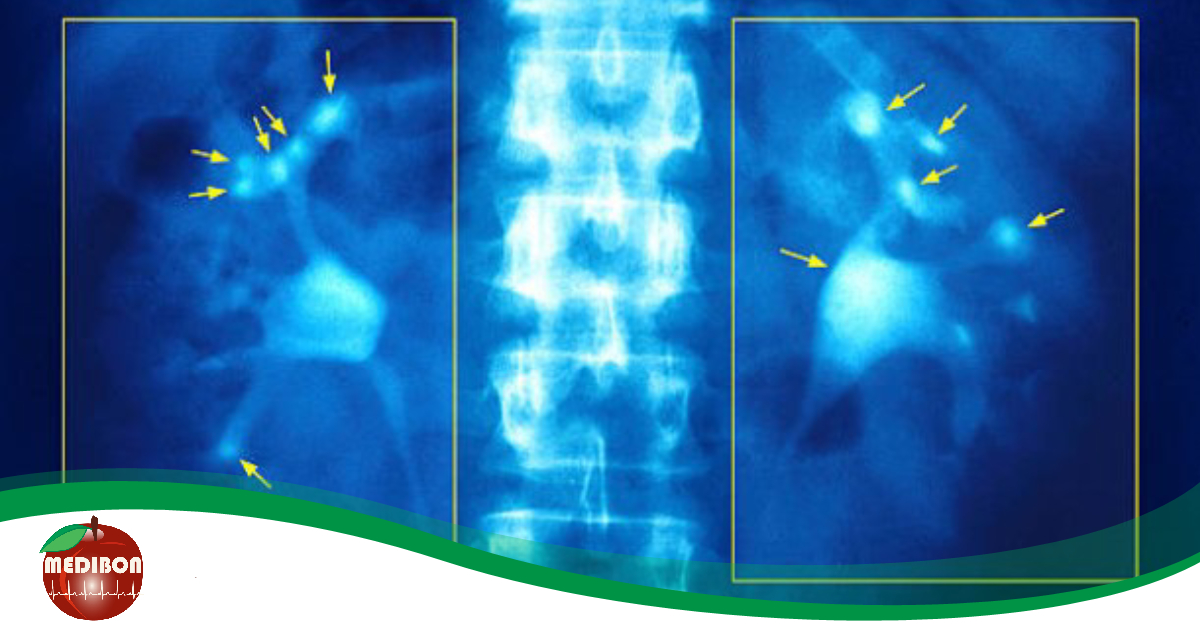 Láss a vesédbe: a vesebetegségek tünetei, megelőzésük