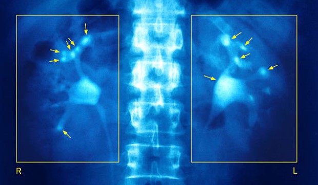 Láss a vesédbe: a vesebetegségek tünetei, megelőzésük