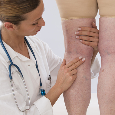 Legyenek szépek a lábaid: ORVOSI visszértágulat eltüntető, megelőző kezelés